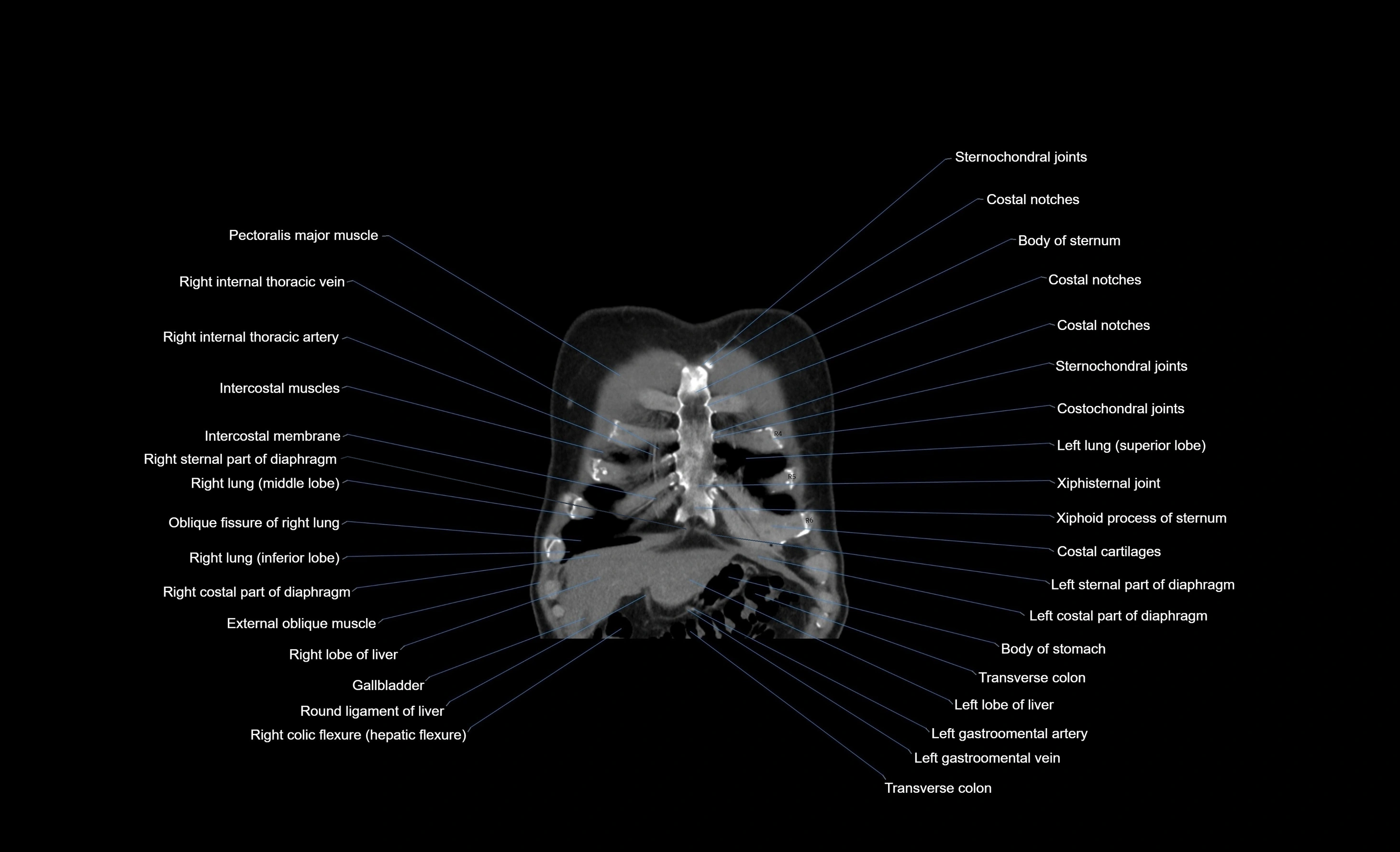 CT chest (thorax) soft tissue window labelled coronal cross sectional anatomy radiology image-00099.webp